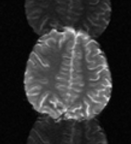 MRI Nyquist N/2 ghost artifact, eddy current