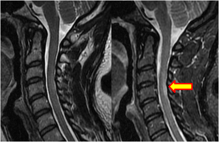 What is a T2 signal in an MRI?