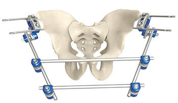 pelvic external fixation device
