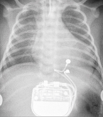 permanent epicardial pacemaker