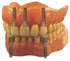 magnetic dentures
