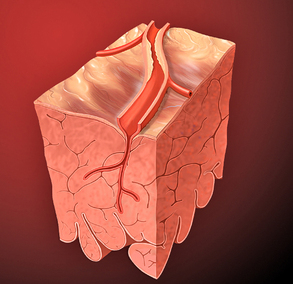 coronary stenosis