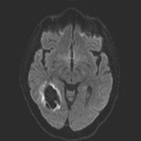 T2 blackout diffusion MRI
