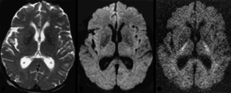 Diffusion MRI increasing b-values brain