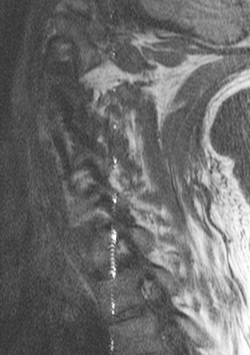 annefact (cusp) artifact MRI
