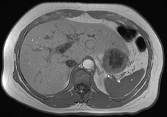 In-phase/Out-of-phase MRI: hepatic steatosis