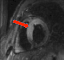 Acute myocardial infarction STIR/T2